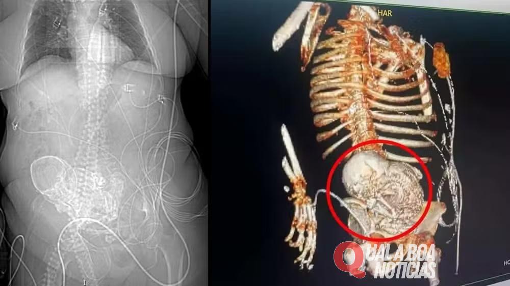 Idosa passou por 3 unidades de saúde antes de descobrir ‘bebê de pedra’
