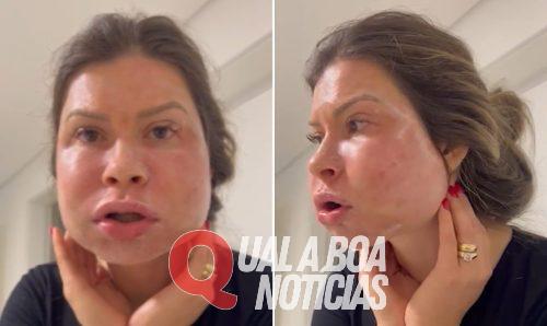 Cascavelense processa Clínica por rosto deformado após procedimento estético: ‘PMMA no lugar de Sculptra’