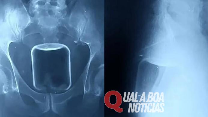 'Que isso Brasil?!': Objeto de quase 1 metro é encontrado em ânus de homem