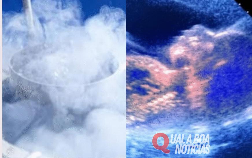 Bebê nasce nos EUA a partir de embrião congelado há 30 anos e quebra recorde mundial